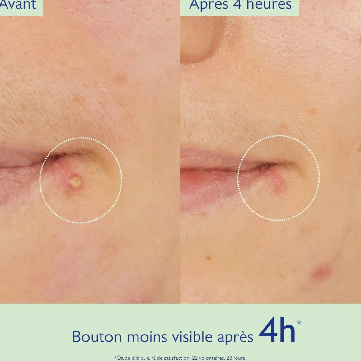 Stop Boutons Salicylique l'Acide Salicylique